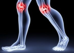 Awọn idi fun idagbasoke ti Kneee arthrosis