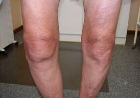 bi o ṣe le tọju arthrosis ti apapọ orokun