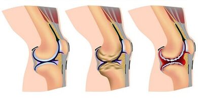 Awọn ipele ti idagbasoke ti arthrosis ti apapọ orokun