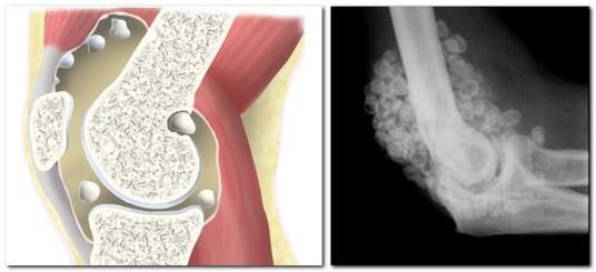 chondromatosis pẹlu irora ni apapọ ibadi