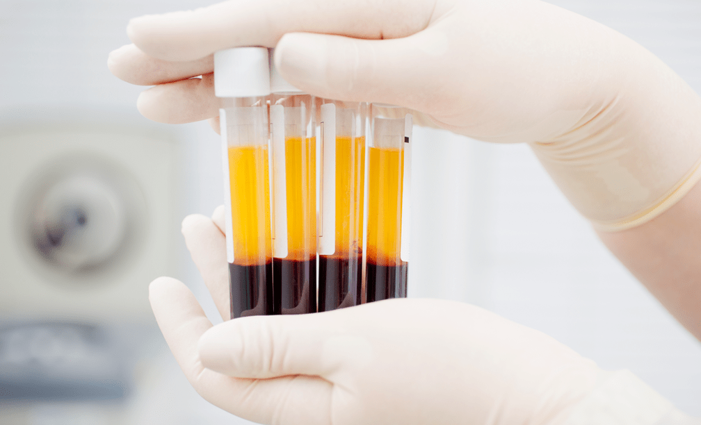 Platelet-ọlọrọ pilasima fun itọju ailera PRP fun arthrosis