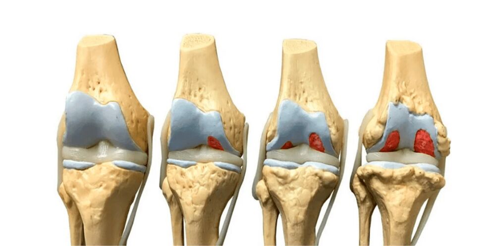 iwọn arthrosis ti awọn isẹpo